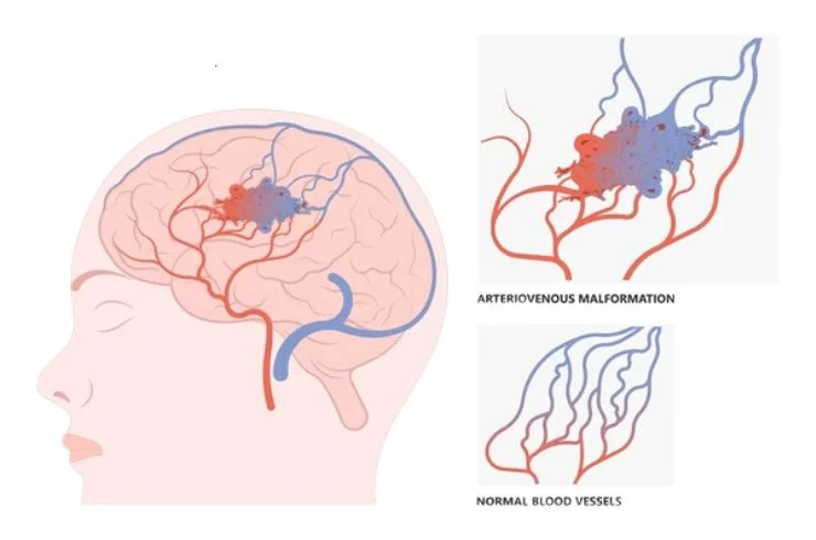 AVM and Tumor Embolization