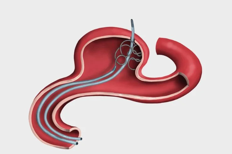 Aneurysm Coiling