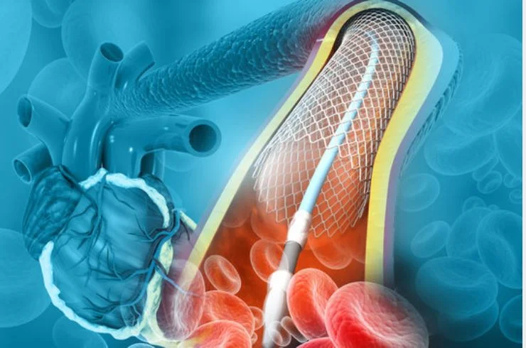 Carotid Stenting