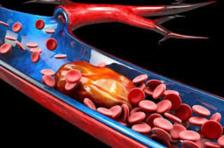 Mechanical Thrombectomy